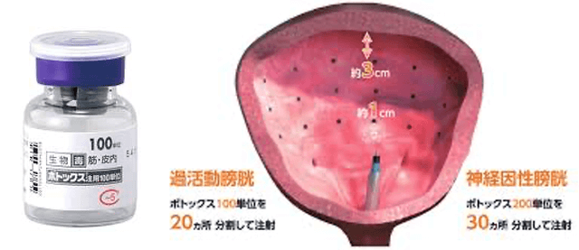 ボツリヌス毒素膀胱内注入療法（2020年から保険承認）