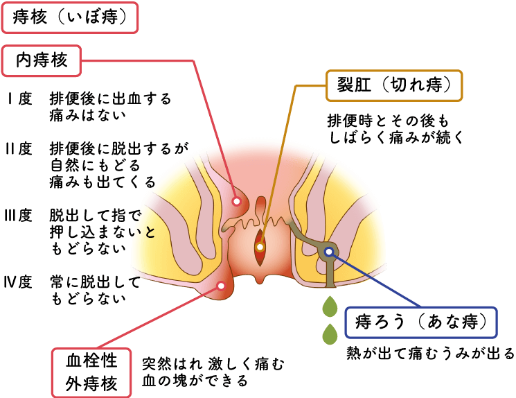 主な肛門疾患と症状