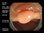 良性（腫瘍性）ポリープ