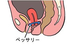 リング治療(ペッサリーの使用)