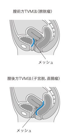 TVM手術とは