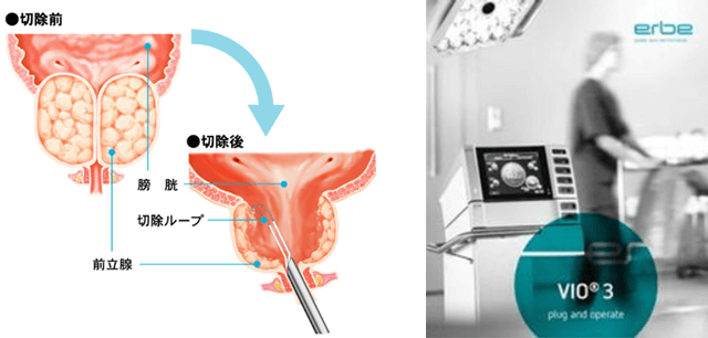 前立腺肥大症に対する経尿道的前立腺切除術（TUR-P）