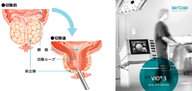 前立腺肥大症に対する経尿道的前立腺切除術(TUR-P)